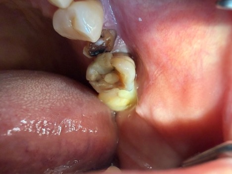 Back tooth before restorative dental treatment in Scarborough