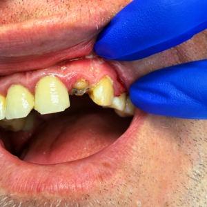 Front teeth before restorative dental treatment in Scarborough
