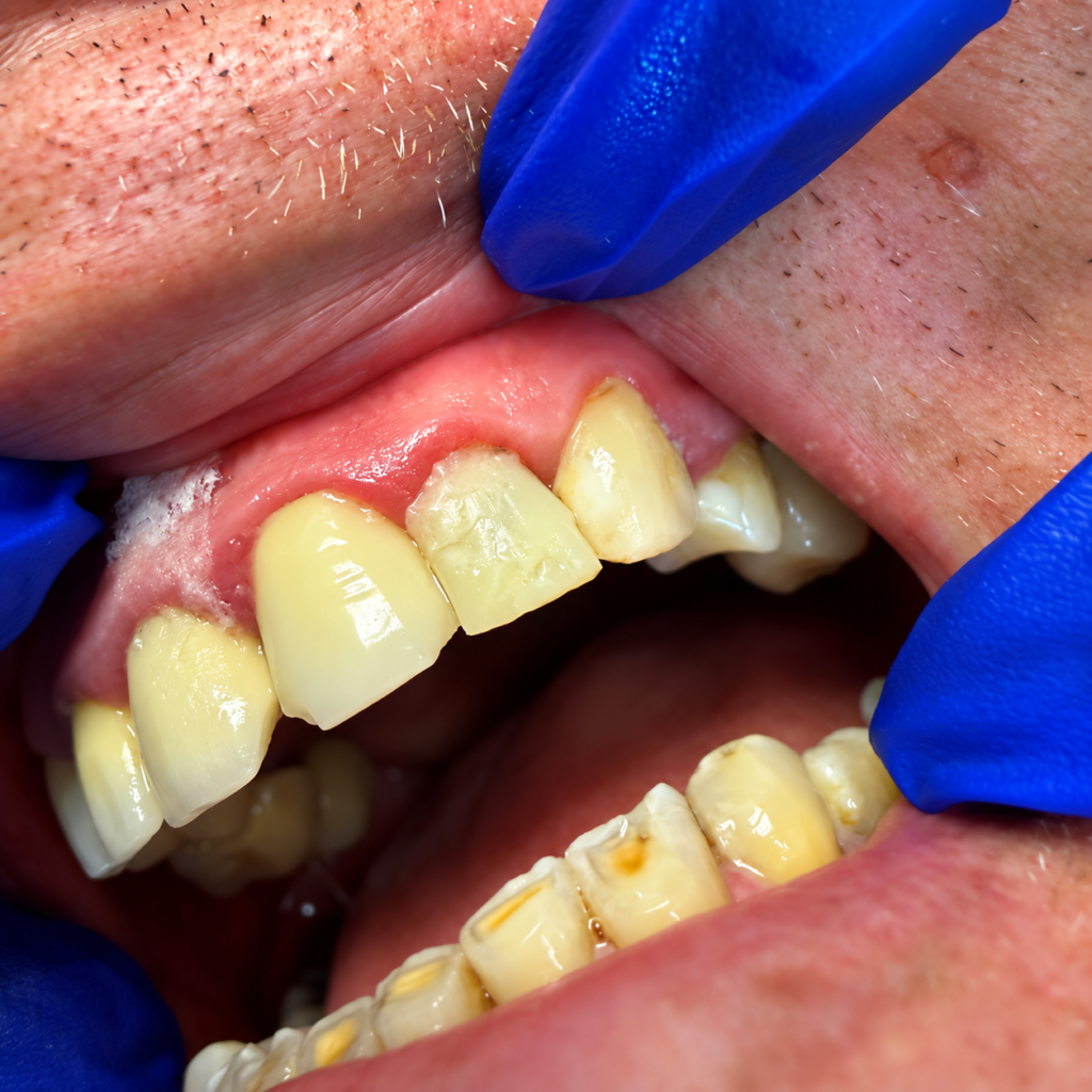 Front tooth during restorative dental treatment at Town Centre Dental Clinic