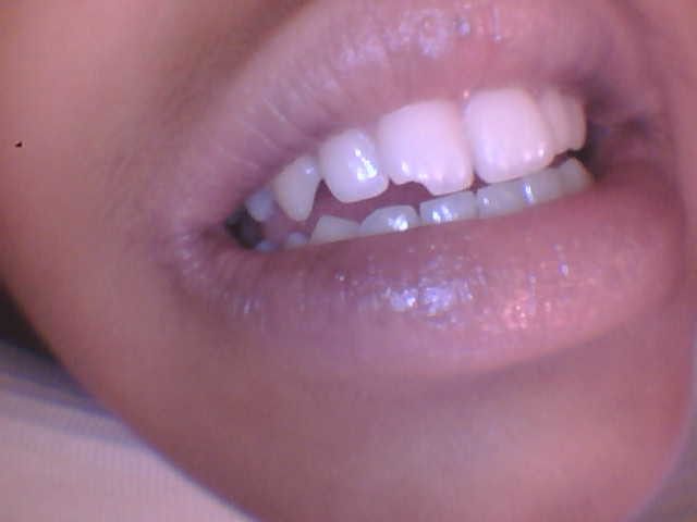 Patient smile before dental treatment at Town Centre Dental Clinic Scarborough